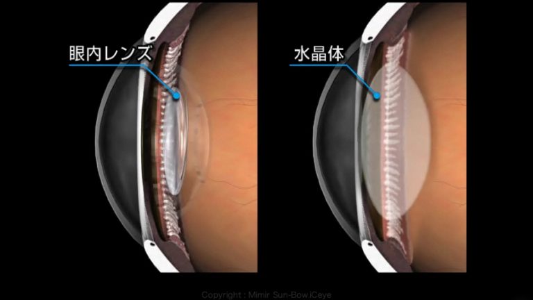 白内障の治療 | 雄山アイクリニック